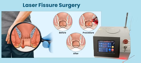 980 nm 1470 nm Diodenlaser für Hämorrhoiden-Chirurgie, Haut-/Evlt-/Pldd-/Zahnlaser